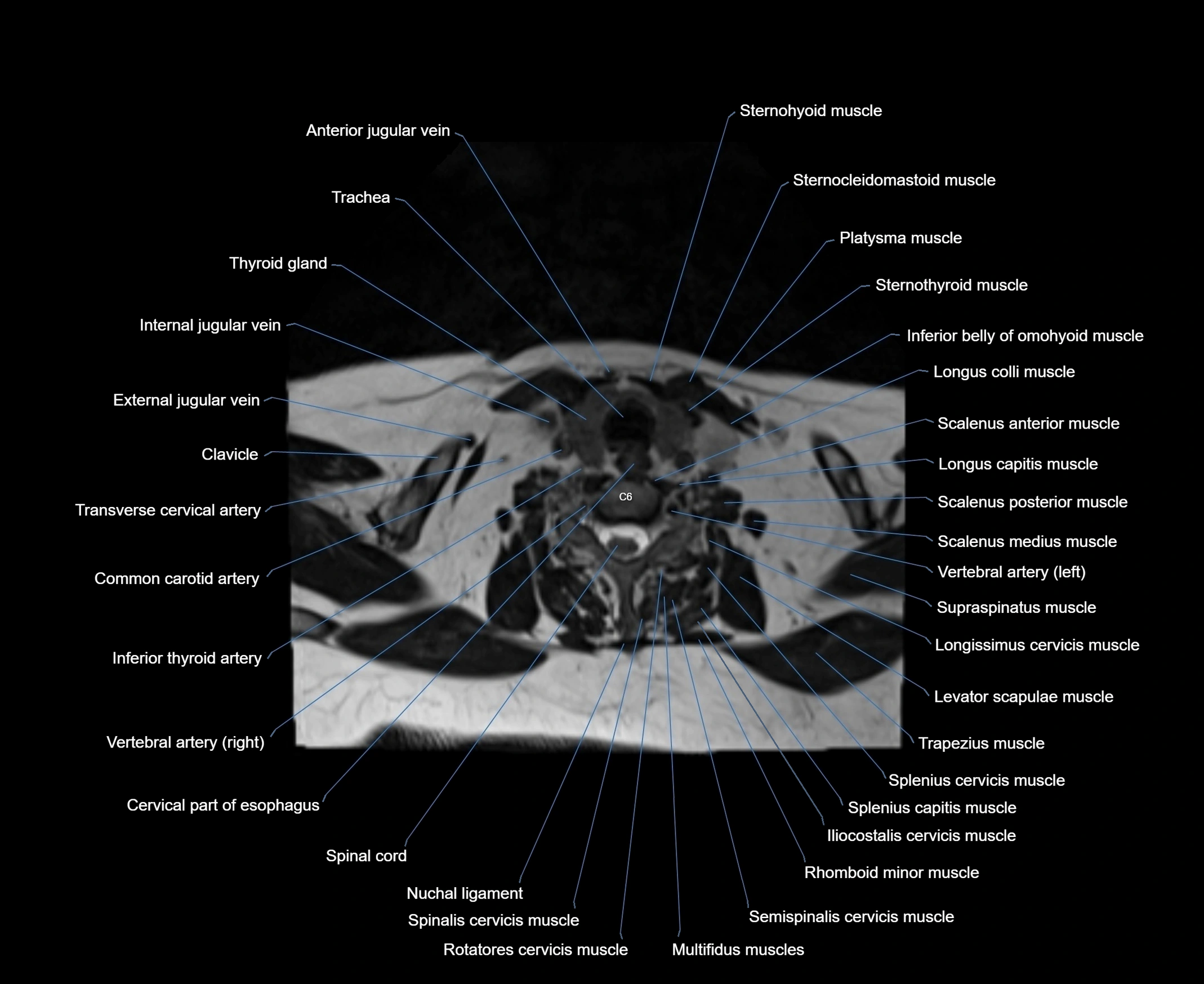 MRI Neck 3D labelled cross section anatomy axial 3t image-00001-00072.webp